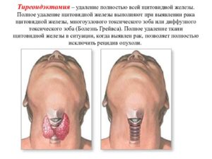 Кто удалял щитовидную железу процесс больничный лист